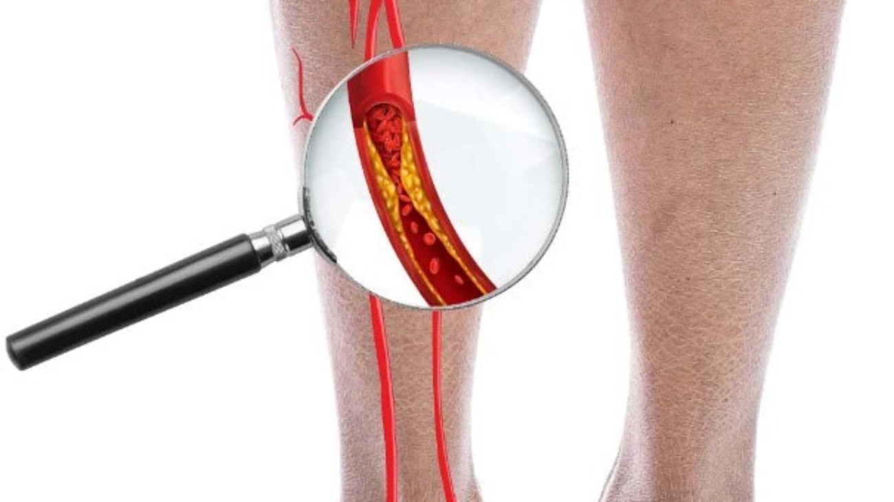 Peripheral Artery Disease