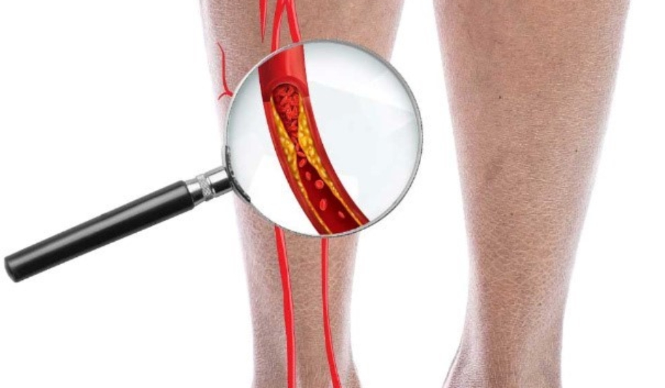 Peripheral Artery Disease